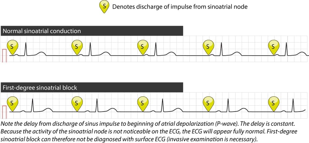 Figure 1. Upper tracing shows normal impulse conduction from the sinoatrial node to the atria. Atrial activation commences almost immediately after discharge of the impulse in the sinoatrial node. Lower tracing shows first-degree sinoatrial block, in which the time interval from impulse discharge to atrial activation is prolonged and this cannot be discerned on the surface ECG. As seen here, the rhythm is still regular and all complexes appear normal.