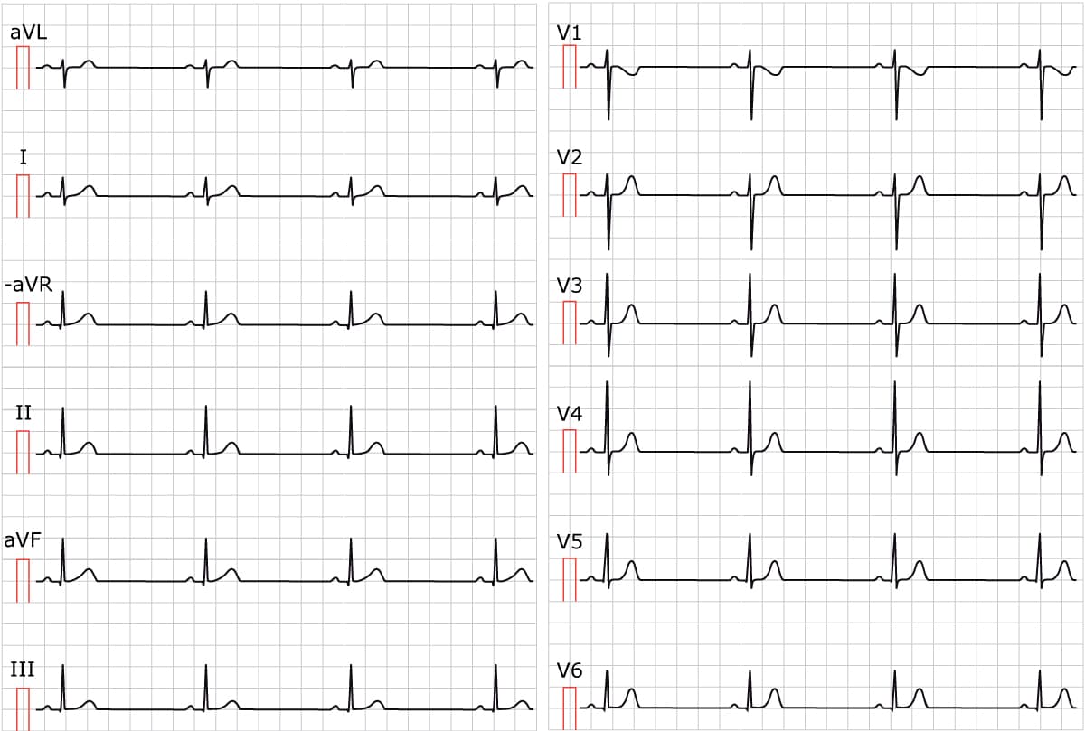 Figure 1. Sinus bradycardia. Paper speed 25 mm/s. Calculate the rate by dividing 300 by the number of large boxes between two cycles (e.g between two R waves). As seen in the figure, there are approximately 6.5 large boxes between two R waves. 300/6.5 equals 46 beats/min.