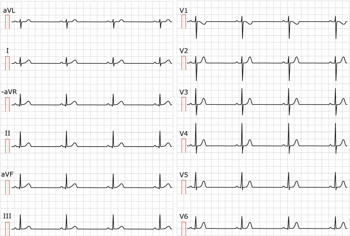 Figure 1. Sinus bradycardia. Paper speed 25 mm/s. Calculate the rate by dividing 300 by the number of large boxes between two cycles (e.g between two R waves). As seen in the figure, there are approximately 6.5 large boxes between two R waves. 300/6.5 equals 46 beats/min.