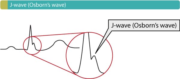 Figure 14. Osborn's wave (J-wave).