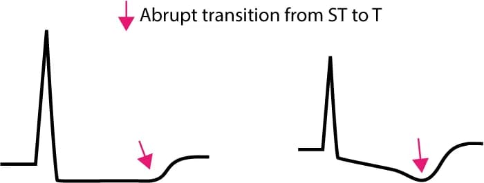 Figure 2. Transition from ST segment to T-wave in ischemia.