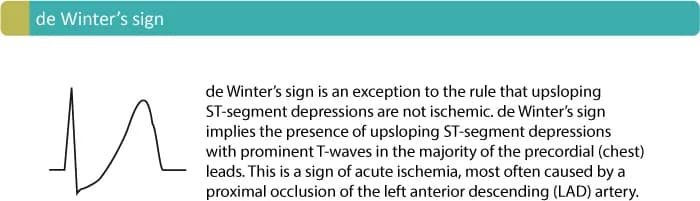 Figure 5. de Winter's sign.