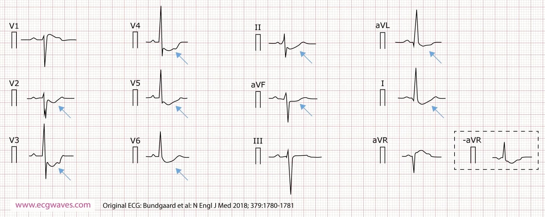Figure 4. 12-lead ECG (presented according to Cabrera), recorded at 63 years of age, demonstrates concave-upward ST-segment depression in leads I, II, aVL, aVF, and V2 through V6; and ST-segment elevation in lead aVR (which corresponds to an identical ST-segment depression in the inverted lead -aVR). A notch is evident in the ascending part of the ST segment.