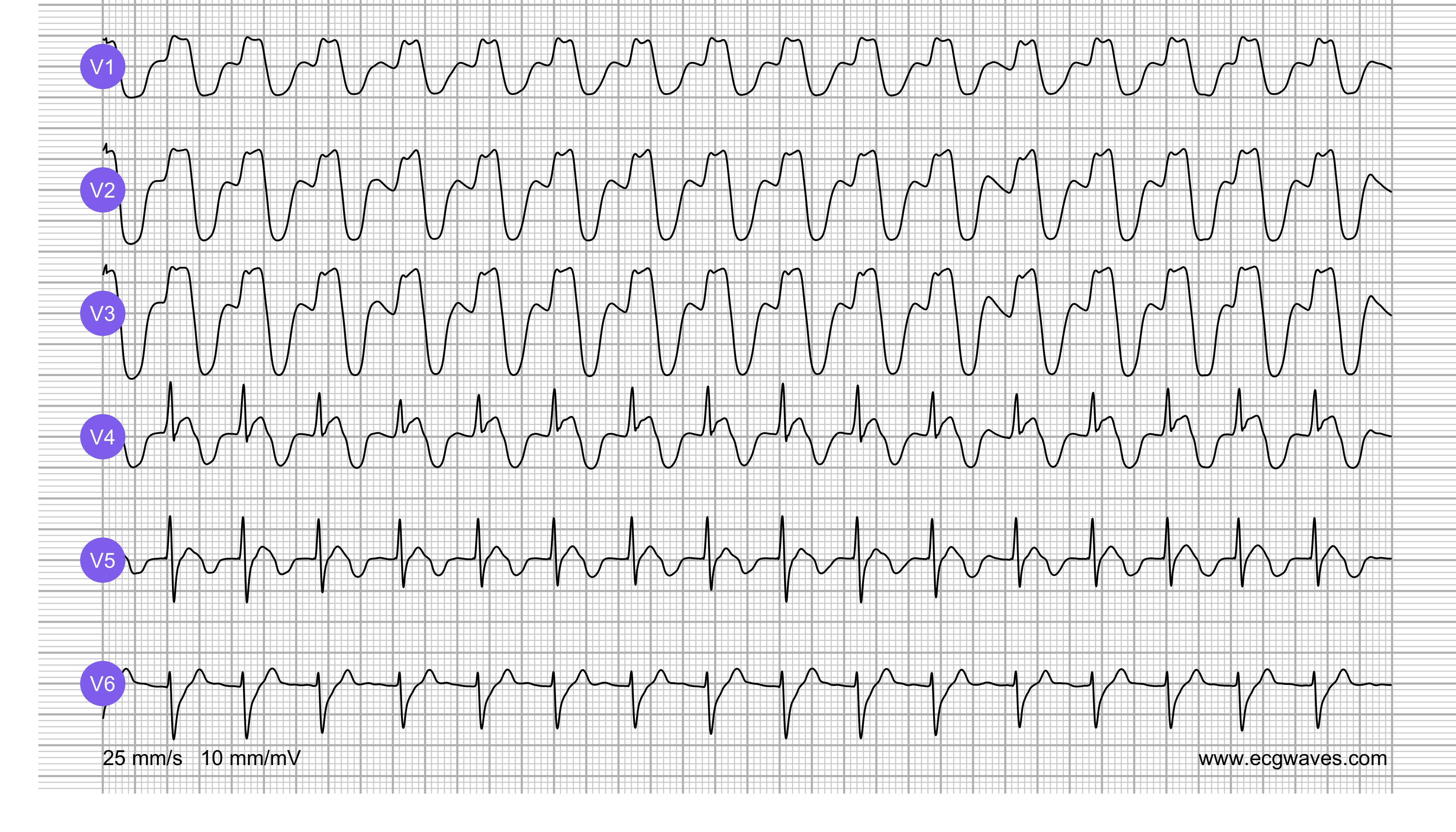 ECG Test (Quiz) Library: Question 1, ECG 2