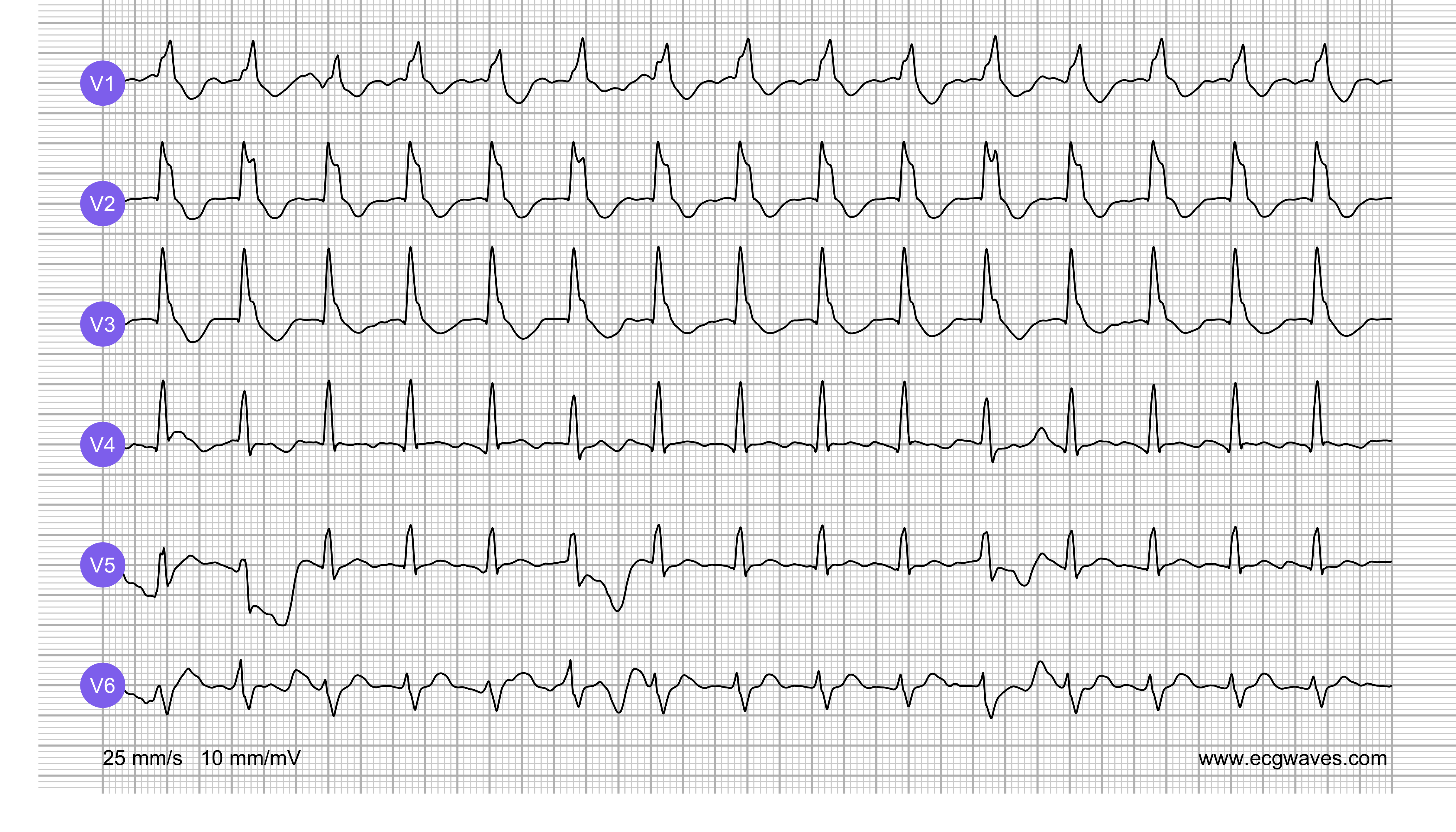 ECG Test (Quiz) Library: Question 4