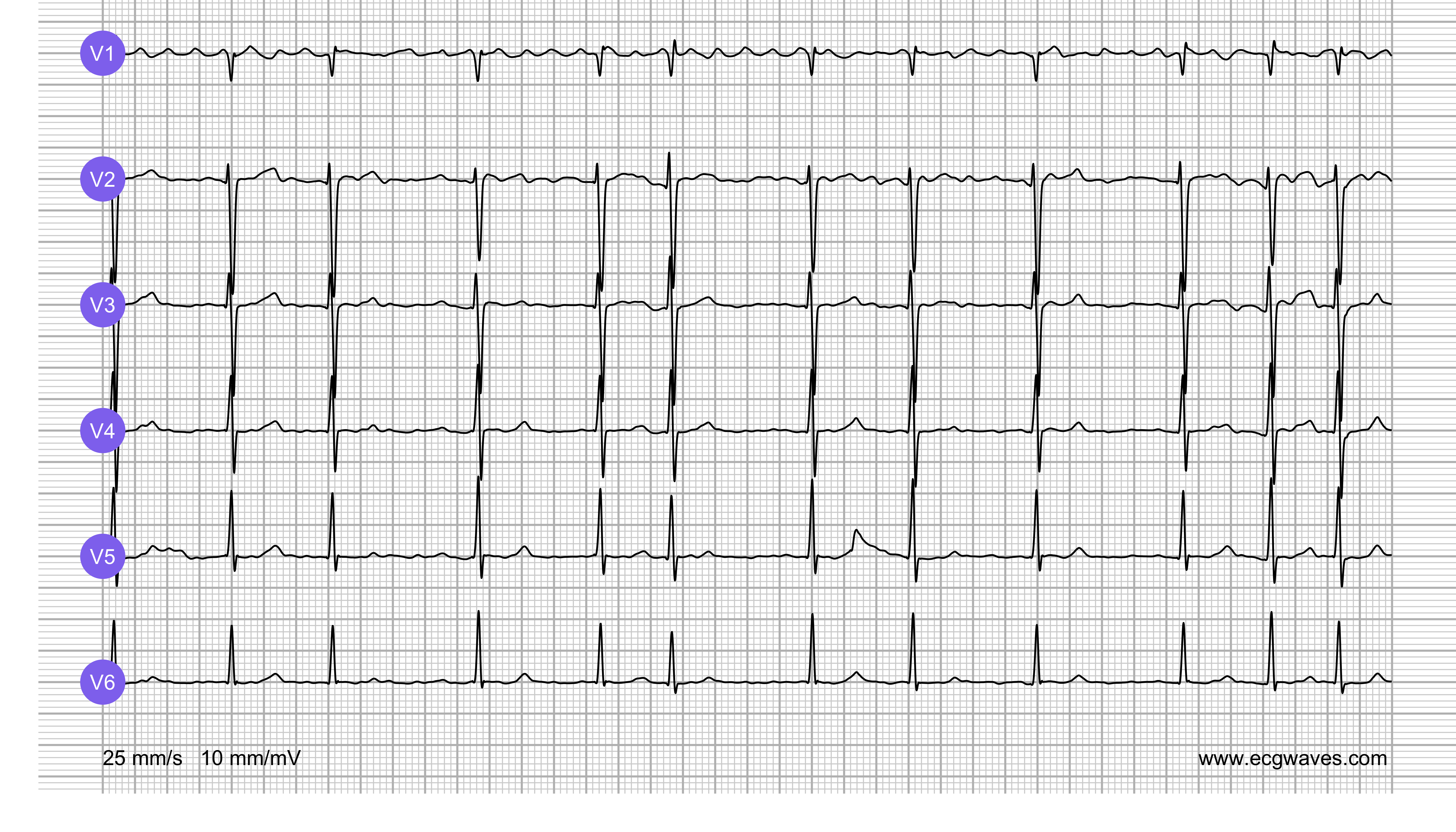 ECG Test (Quiz) Library: Question 5