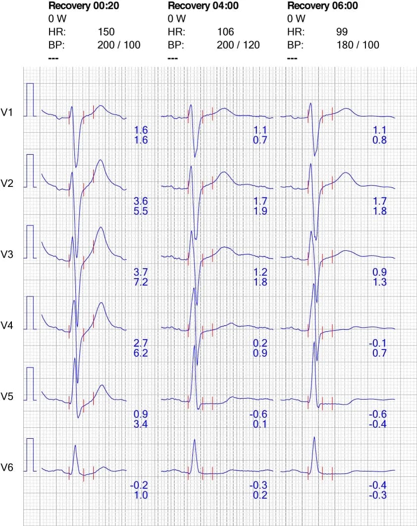 Figure 10. ECG reaction in chest leads during recovery.