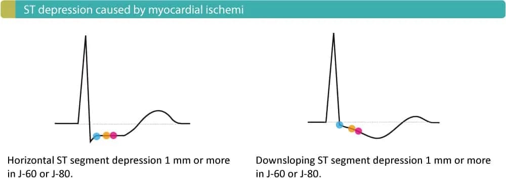 Figure 3. ST segment depressions that are typical of ongoing myocardial ischemia.
