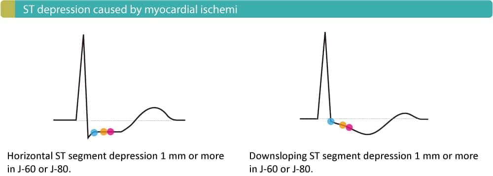 Figure 3. ST segment depressions that are typical of ongoing myocardial ischemia.