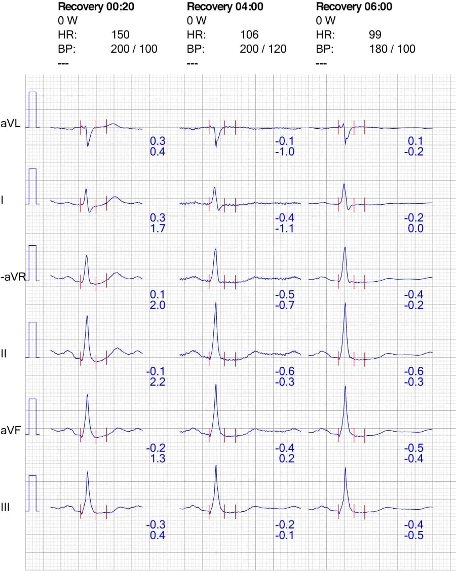 Figure 8. ECG reaction in limb leads during recovery.