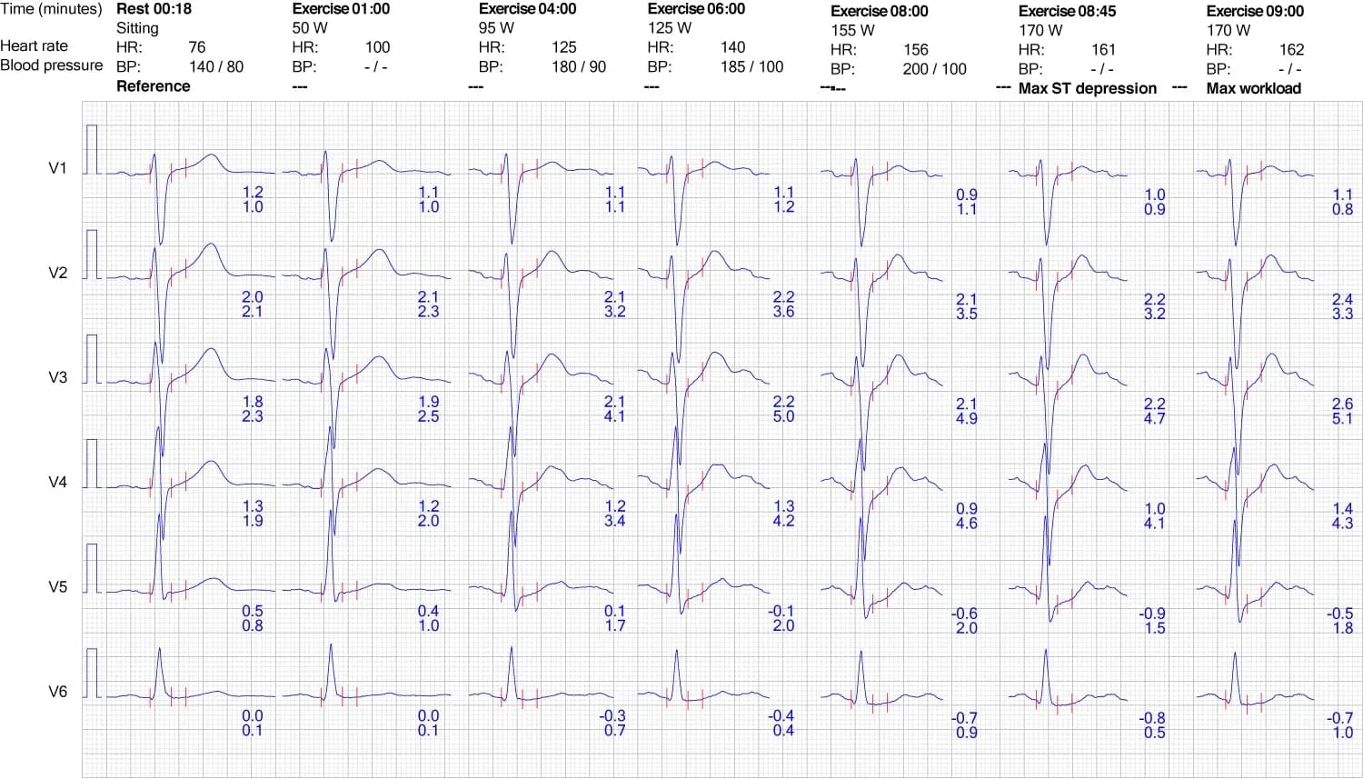 Figure 9. ECG reaction in chest leads during exercise.