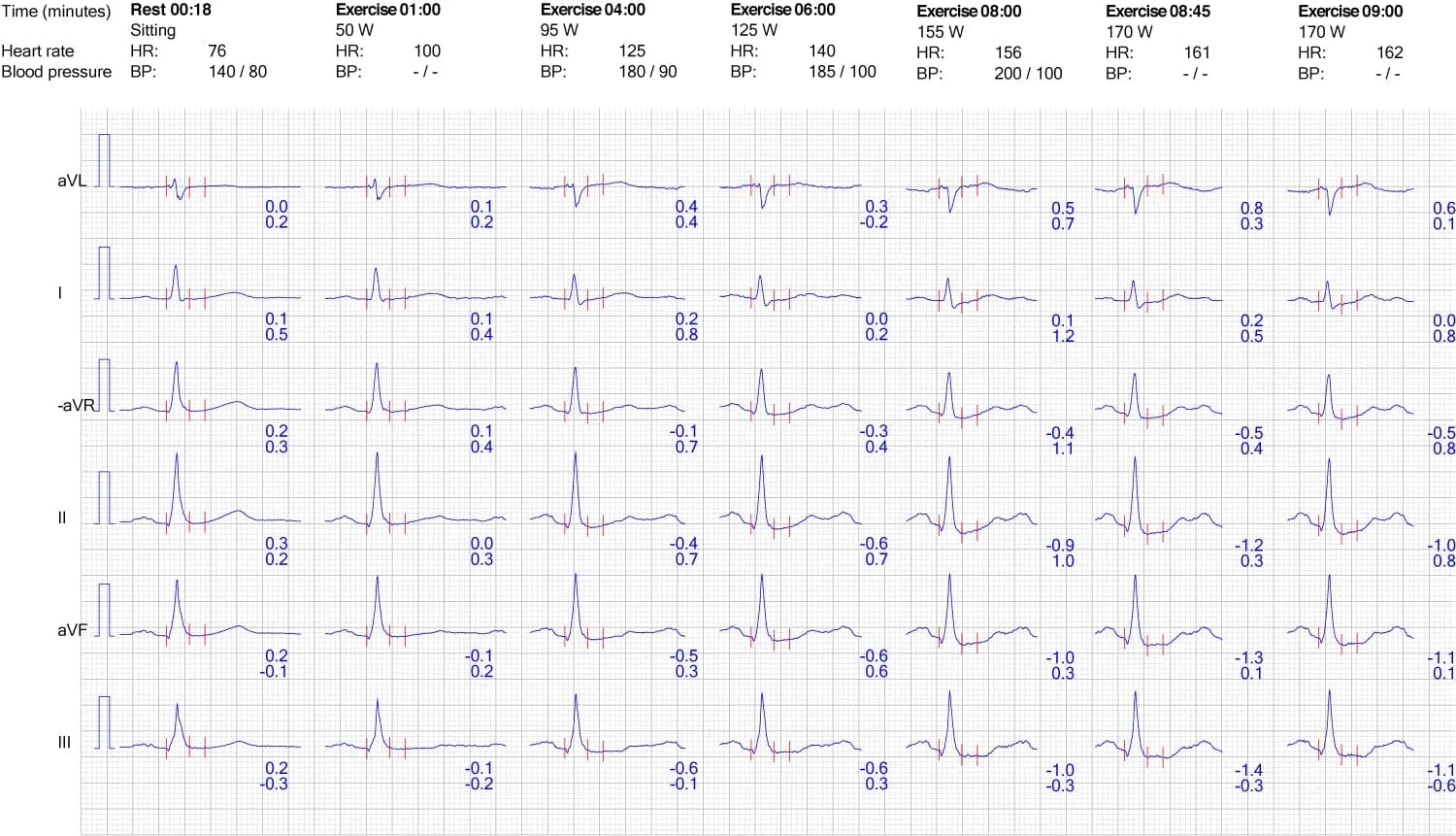 Figure 7. ECG reaction in limb leads during exercise.