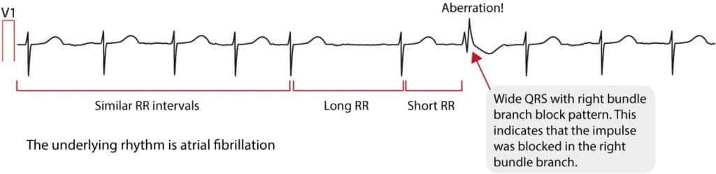 Figure 2. Ashman's phenomenon.