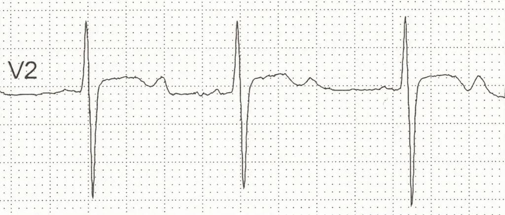 Figure 3. Hypokalemia.