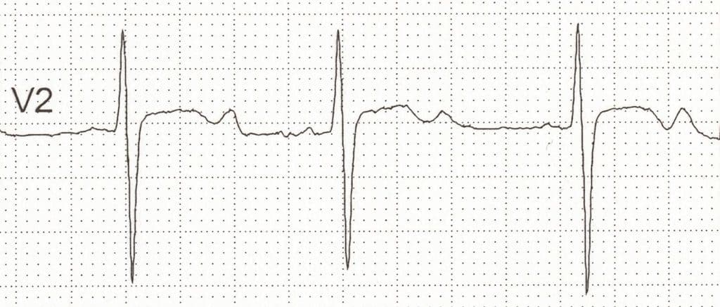 Figure 3. Hypokalemia.