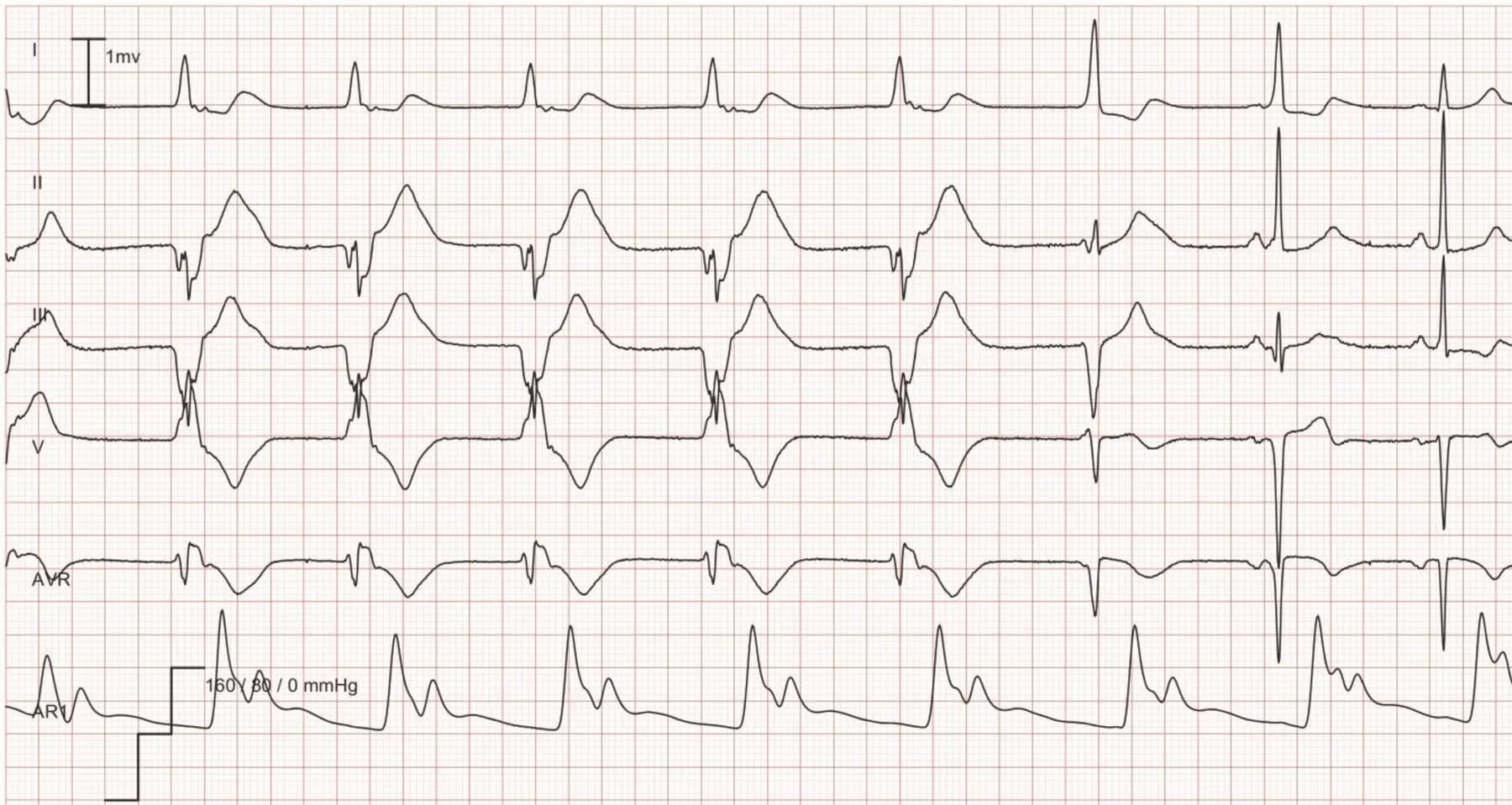 ECG Example: Idioventricular rhythm (accelerated ventricular rhythm) – Accelerated ventricular rhythm at a rate of 56 for the first 5 beats followed by 2 fusion beats; the last 2 beats are normal sinus rhythm.