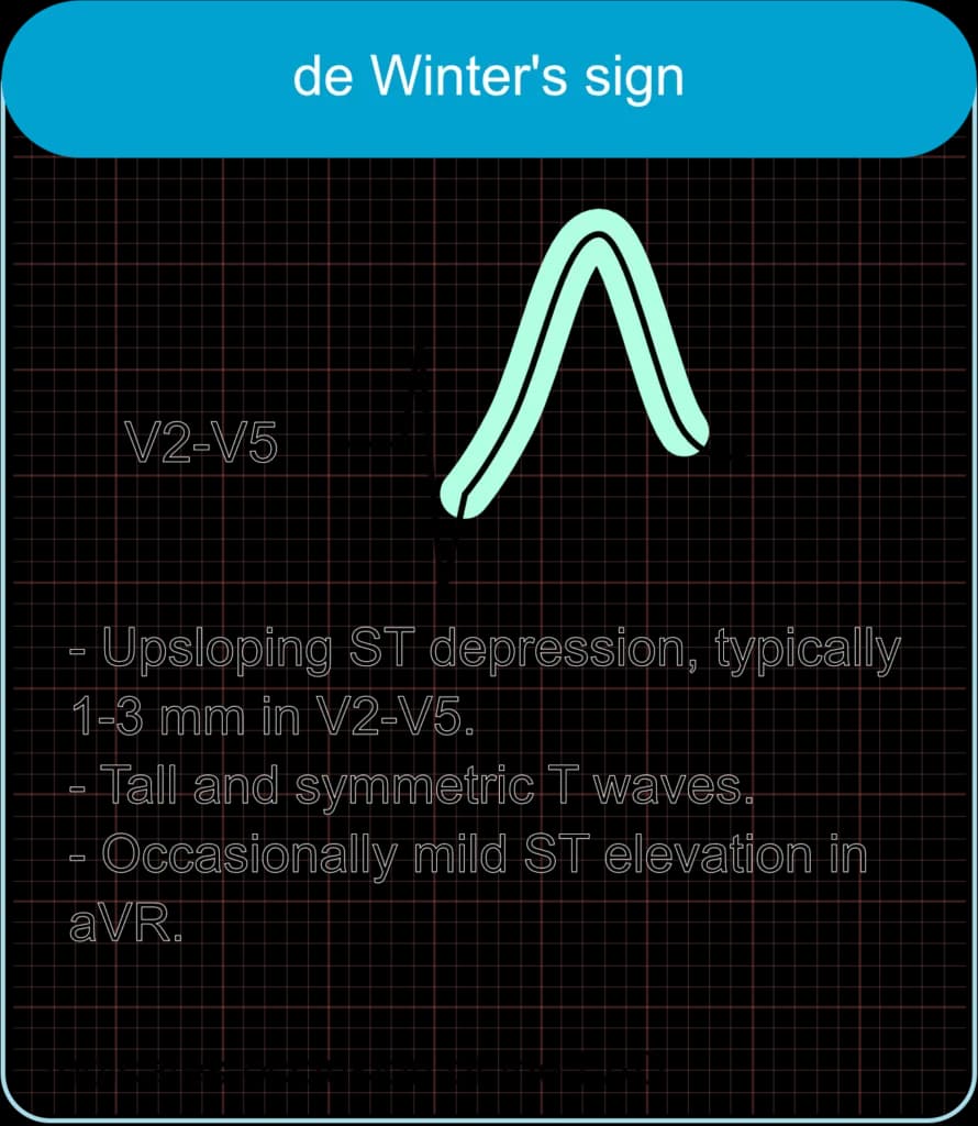 De Winter T-waves (De Winter sign)