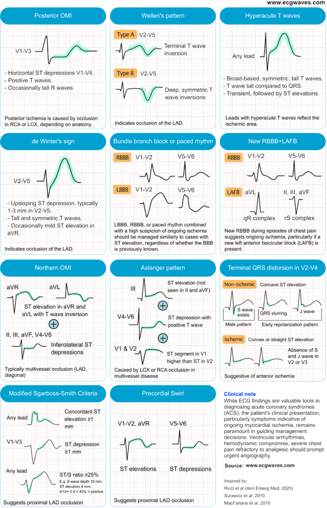 Figure 1. ECG patterns suggestive of acute coronary occlusion (ACO).