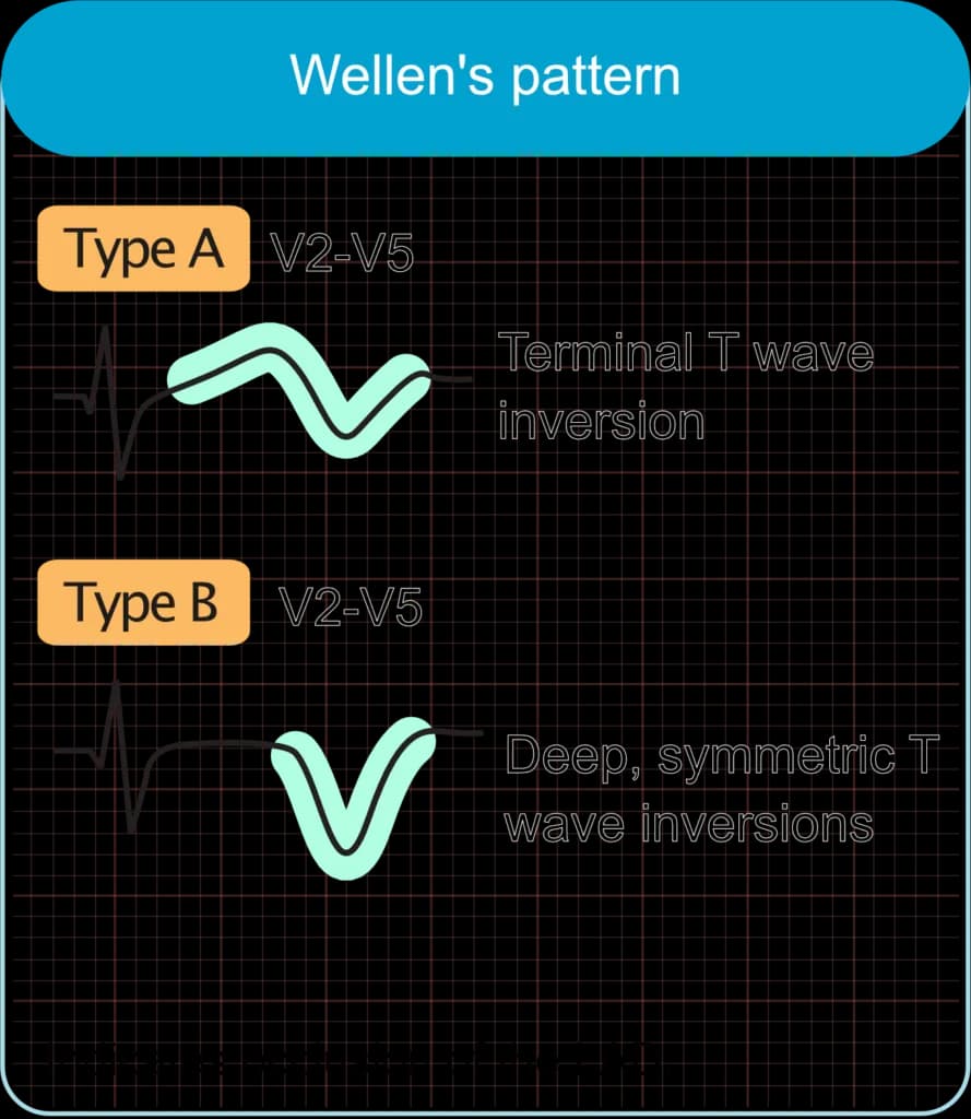 Wellens Syndrome (Wellens ECG pattern)