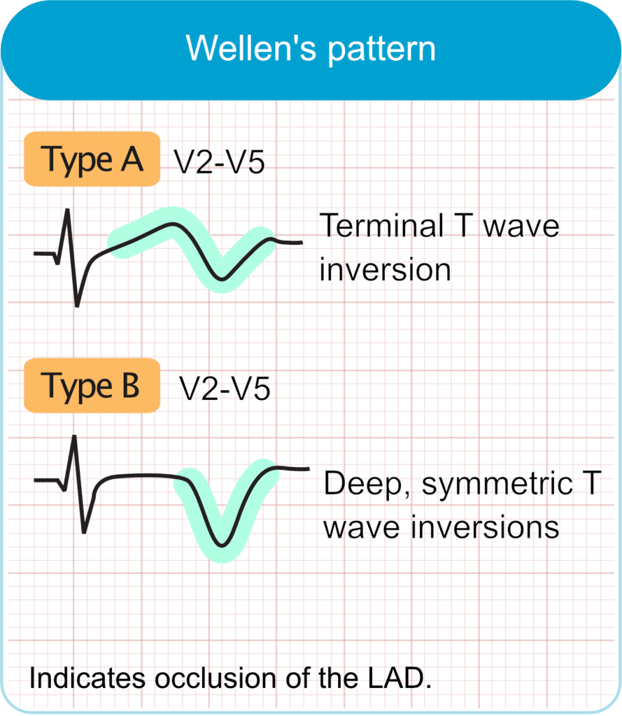 Wellens Syndrome (Wellens ECG pattern)