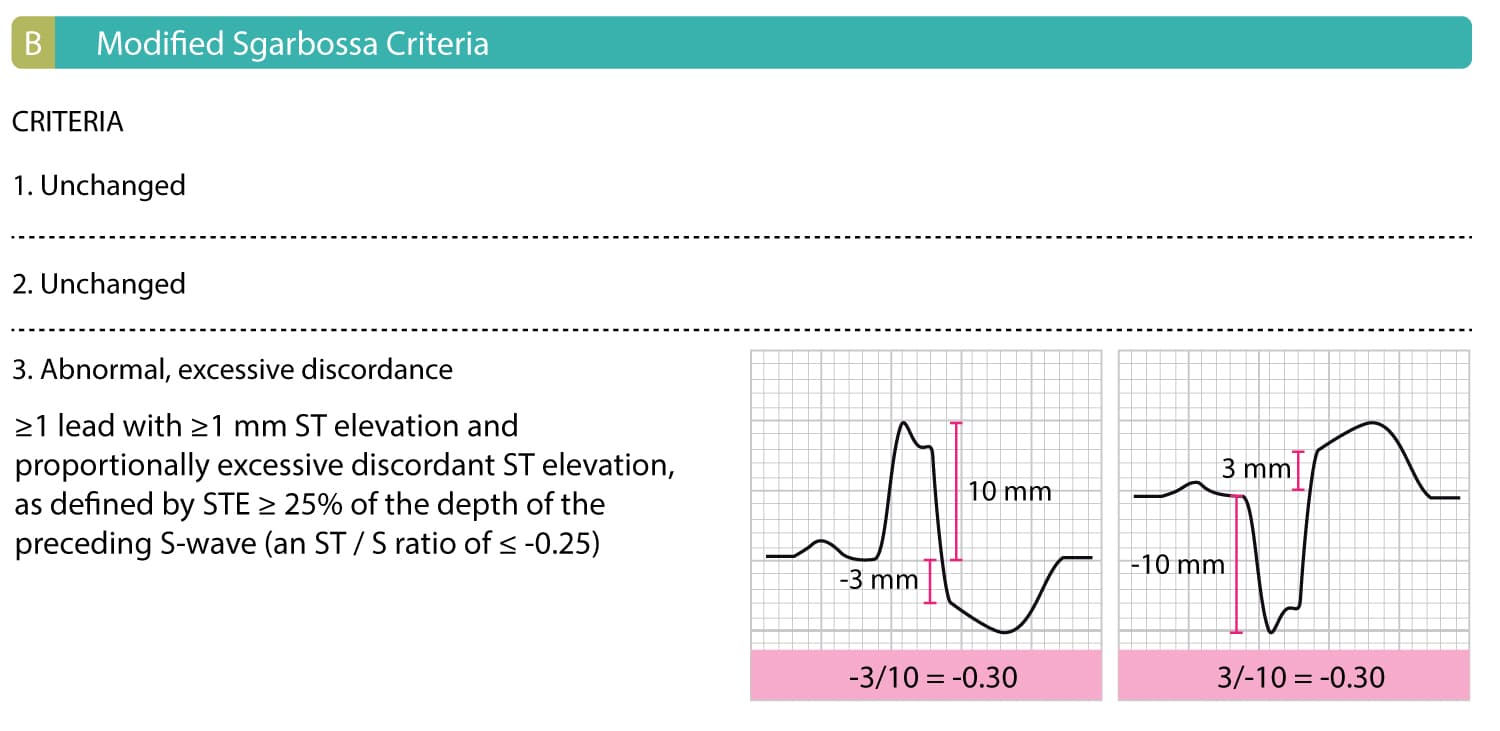 Figure 1B: Criteria 1 and 2 of the original Sgarbossa criteria are unchanged. The R or S wave, whichever is most prominent, and ST segments (relative to the PR segment), is measured to the nearest 0.5 mm. The ST/S ratio is calculated for each lead that has both discordant ST deviation ≥1 mm.