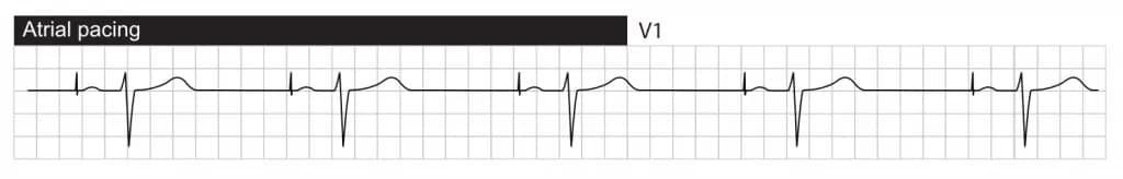 Atrial pacing with normal conduction to the ventricles via the AV system. The ventricles are depolarized via the His-Purkinje network, resulting in normal QRS duration.