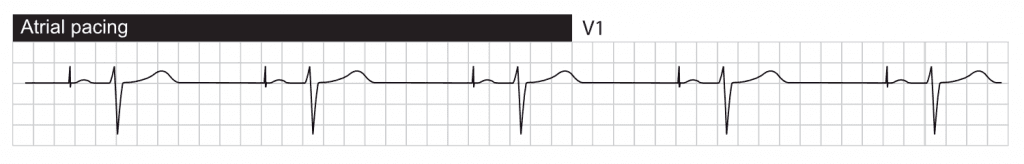 Atrial pacing with normal conduction to the ventricles via the AV system. The ventricles are depolarized via the His-Purkinje network, resulting in normal QRS duration.