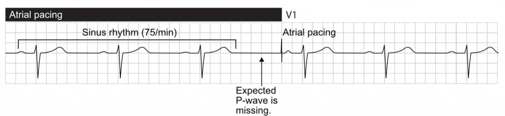 Missing, or delayed, sinus impulse invokes atrial pacing.