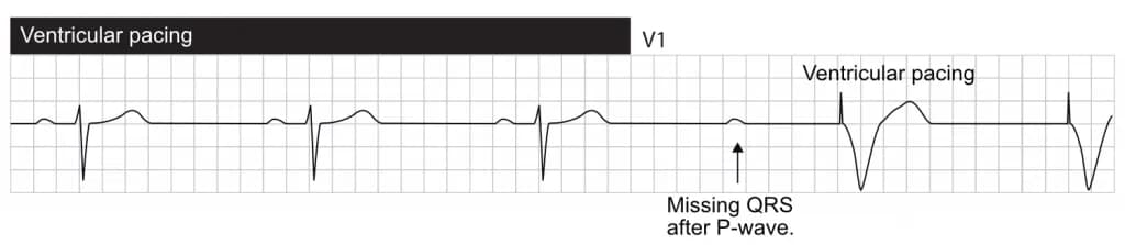 AV block (blocked P-wave) resulting in ventricular pacing.