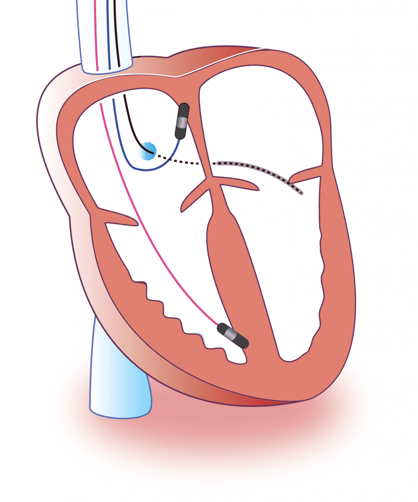 Figure 5. Cardiac resynchronization therapy (CRT)