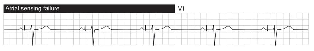 Failure to sense. Atrial pacing occurs after the intrinsic P-wave.