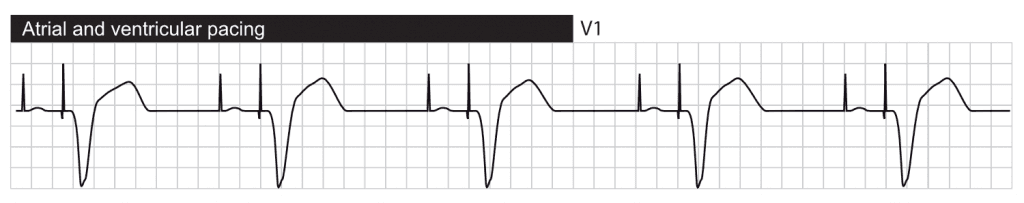 Pacing in right atrium and right ventricle.