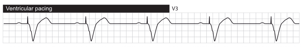 Spontaneous atrial activity is sensed by the atrial lead and results in ventricular stimulations. The QRS complex is wide due to ventricular depolarization proceeding partly or fully outside the conduction system.