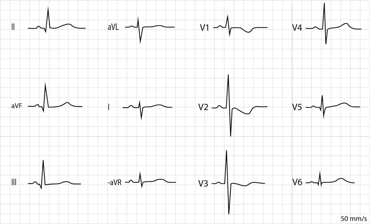 Figure 3. ECG recorded in a 8 days old female. The electrical axis is deviated rightwards (negative QRS i lead I and positive QRS in lead II). The R-waves are prominent in leads V1, V2 and V3. There are negative T-waves in V1–V3, which are also normal. There are Q-waves in inferior limb leads (II, aVF and III) and lateral chest leads (V5, V6). 