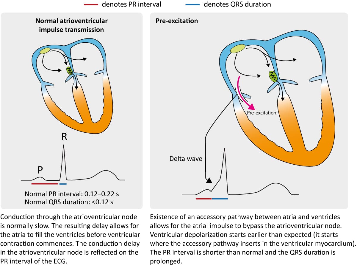 Figure 1. Hallmarks of pre-excitation on the ECG.
