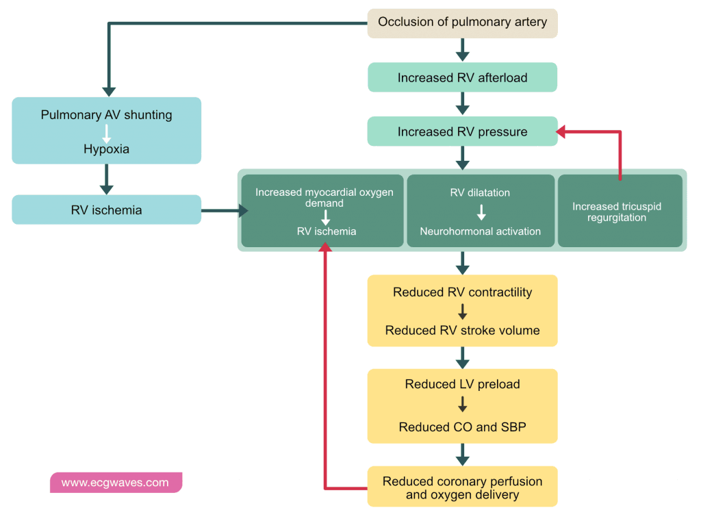Pathophysiology of pulmonary embolism (PE).