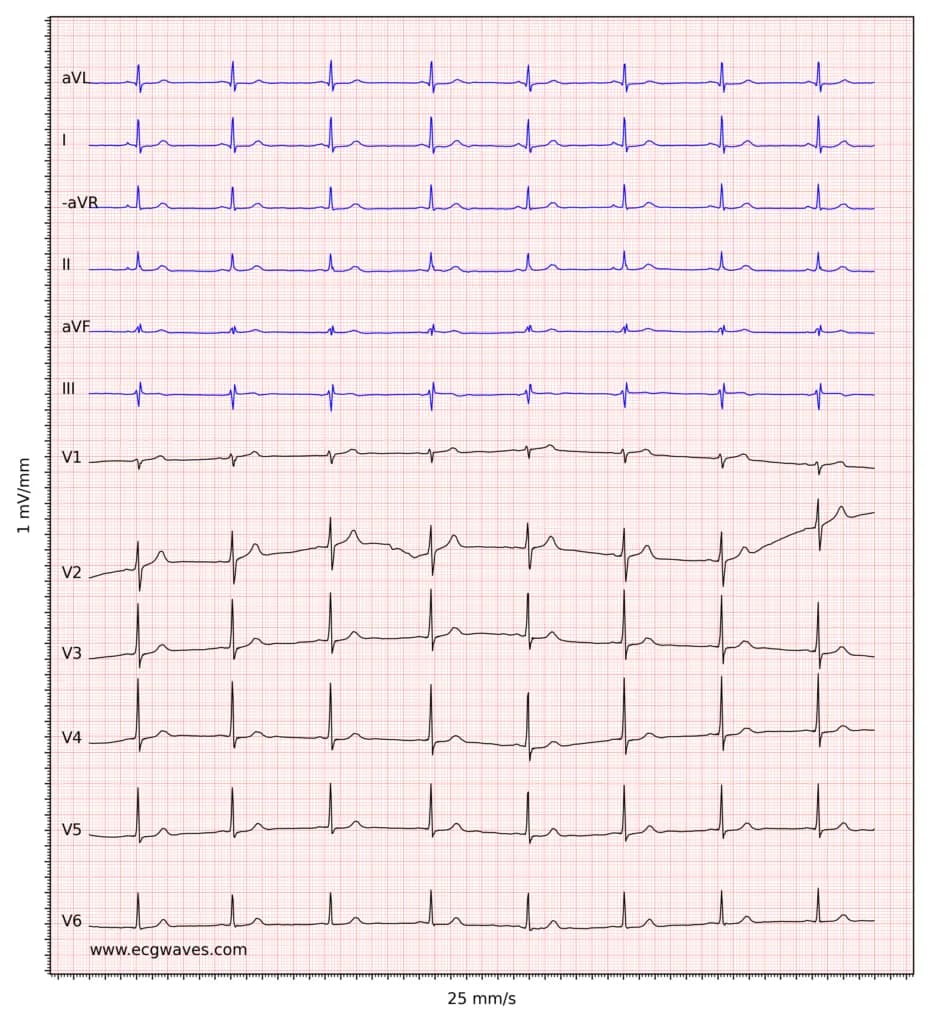 Figure 4. Sinus bradycardia.