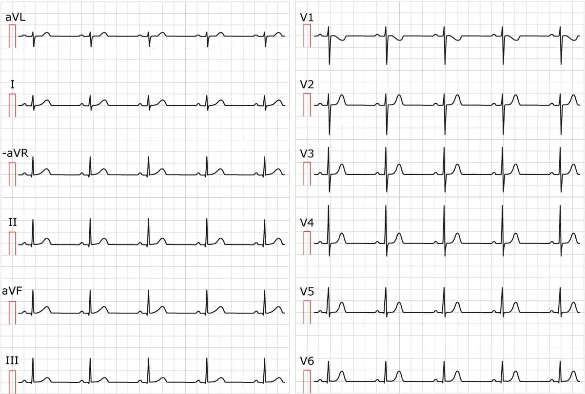 Figure 1. Sinus rhythm. Paper speed 25 mm/s.