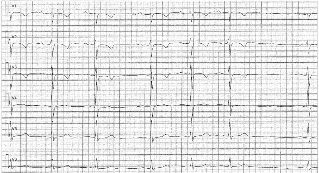 Figur 4. Sinusarytmi med sinuspaus. Negativa T-vågor är normalt i V1–V3 (patienten var 15 år gammal när EKG registrerades).