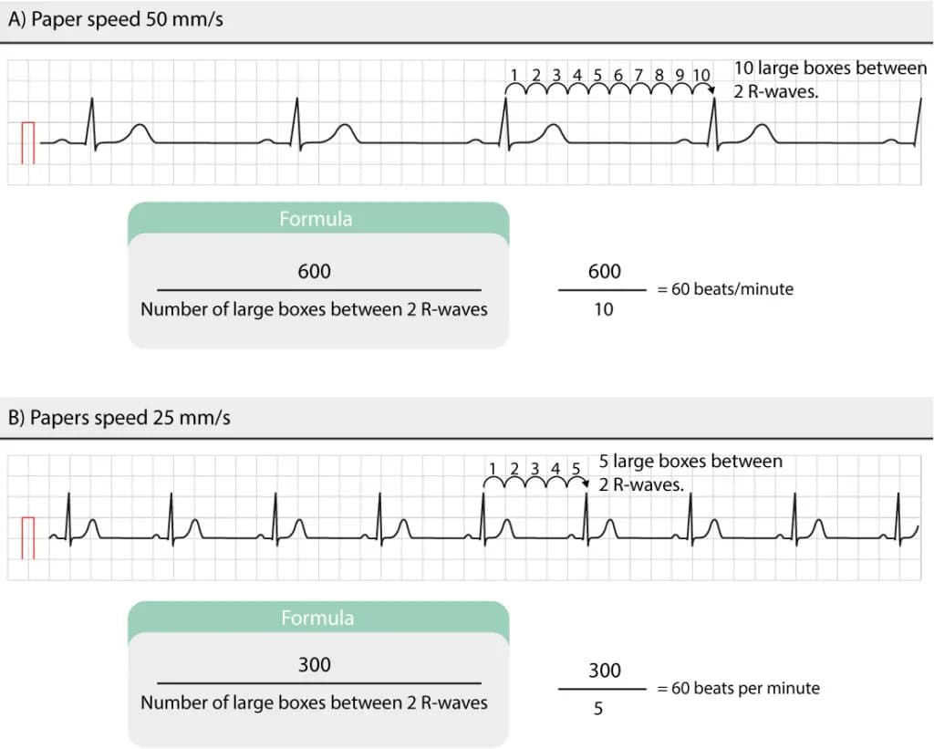 Figure 3. Manual calculation of heart rate.