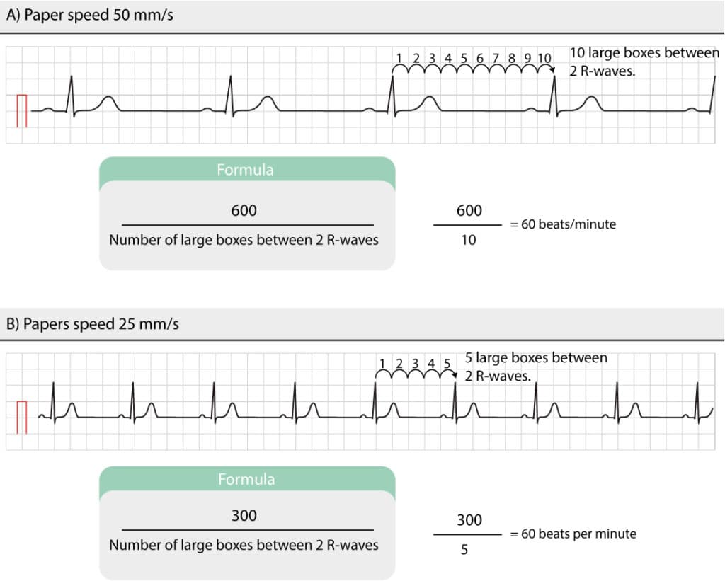 Figure 3. Manual calculation of heart rate.