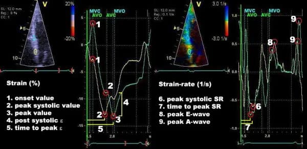Figure 7. Parameters on strain and strain rate diagrams. Both panels show the same myocardial area, i.e basal septum. Source | Lisence.