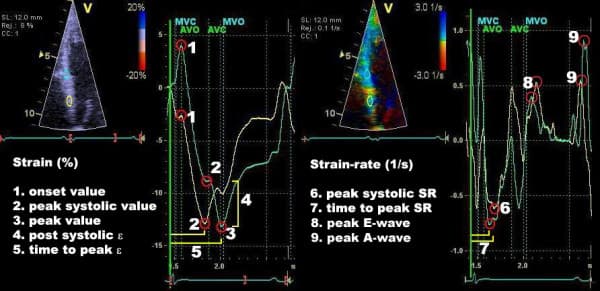 Figure 7. Parameters on strain and strain rate diagrams. Both panels show the same myocardial area, i.e basal septum. Source | Lisence.