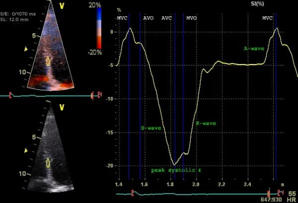 Figure 5. Examination of strain (longitudinal strain) with tissue Doppler. Septal strain is examined. Y-axis depicts strain (% deformation) and X-axis depicts time. Source | License.
