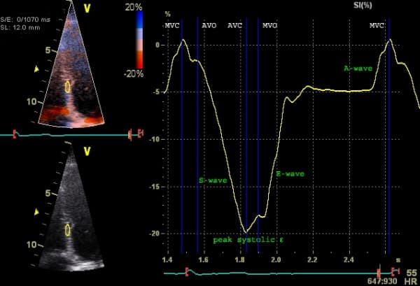 Figure 5. Examination of strain (longitudinal strain) with tissue Doppler. Septal strain is examined. Y-axis depicts strain (% deformation) and X-axis depicts time. Source | License.