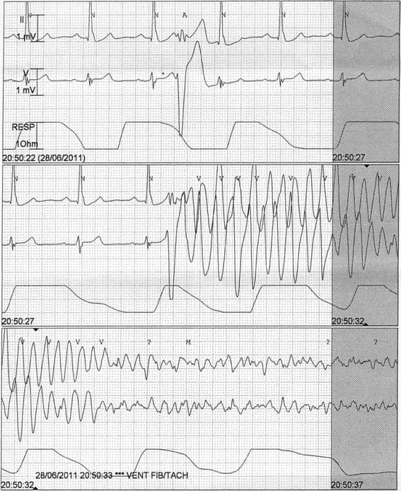 ECG showing polymorphic ventricular tachycardia degenerating into ventricular fibrillation. By Bagnall et al: BMC Medical Genetics 15 (2014): 99.