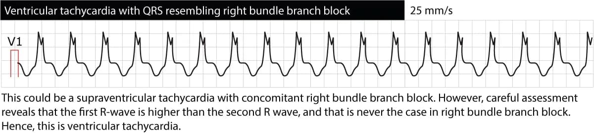 Figure 4. Ventricular tachycardia with right bundle branch block (RBBB) morphology. However, the first R-wave is larger than the second R-wave, which is not the case in RBBB. This suggests that the rhythm is not a supraventricular tachycardia conducted with RBBB, but rather ventricular tachycardia (VT).