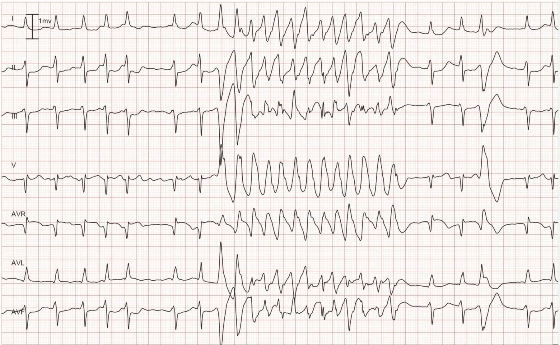 Figure 8. Lead I, II, III, V1 aVR, aVL and aVF. As seen in the beginning of the recording, the patient has an underlying rhythm of atrial fibrillation. The atrial fibrillation is interrupted by a rapid and regular tachycardia with wide QRS complex. Note the 4th beat from the end; it is a premature ventricular beat and its QRS morphology is identical to the QRS seen during the tachycardia. Hence, the tachycardia also originates from the ventricles, which implies that it is ventricular tachycardia (VT).