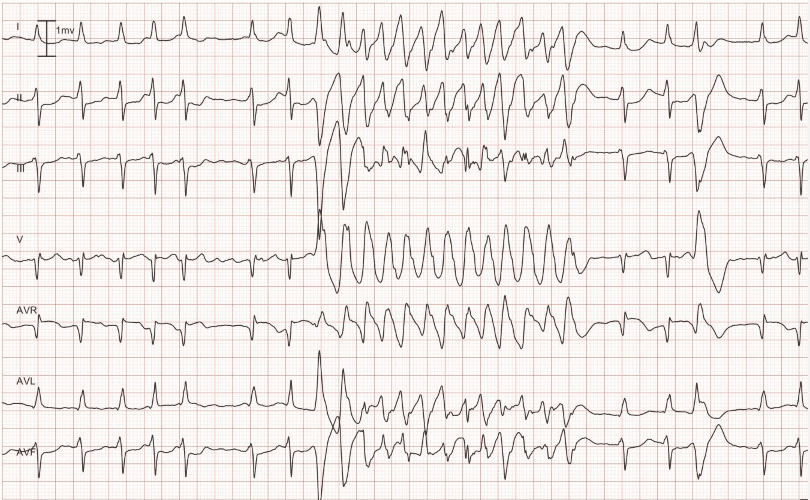 Figure 8. Lead I, II, III, V1 aVR, aVL and aVF. As seen in the beginning of the recording, the patient has an underlying rhythm of atrial fibrillation. The atrial fibrillation is interrupted by a rapid and regular tachycardia with wide QRS complex. Note the 4th beat from the end; it is a premature ventricular beat and its QRS morphology is identical to the QRS seen during the tachycardia. Hence, the tachycardia also originates from the ventricles, which implies that it is ventricular tachycardia (VT).