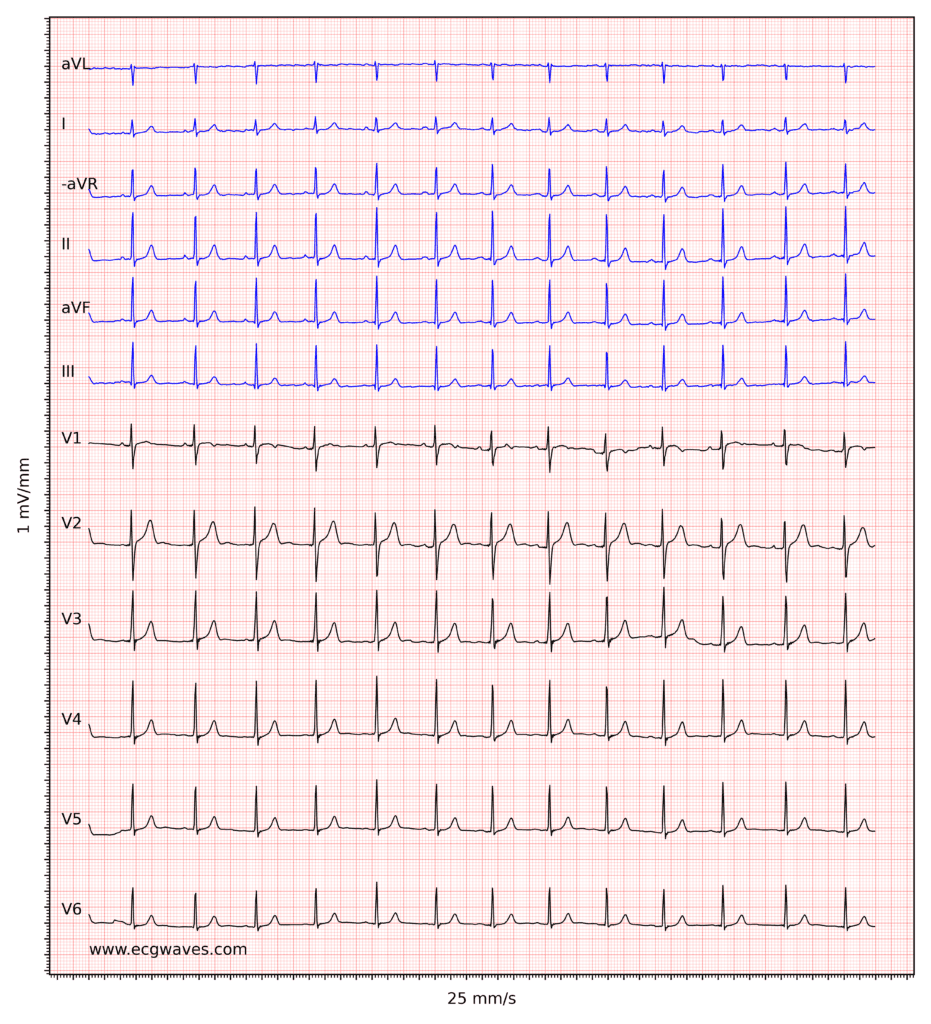 Characteristics of the Normal ECG
